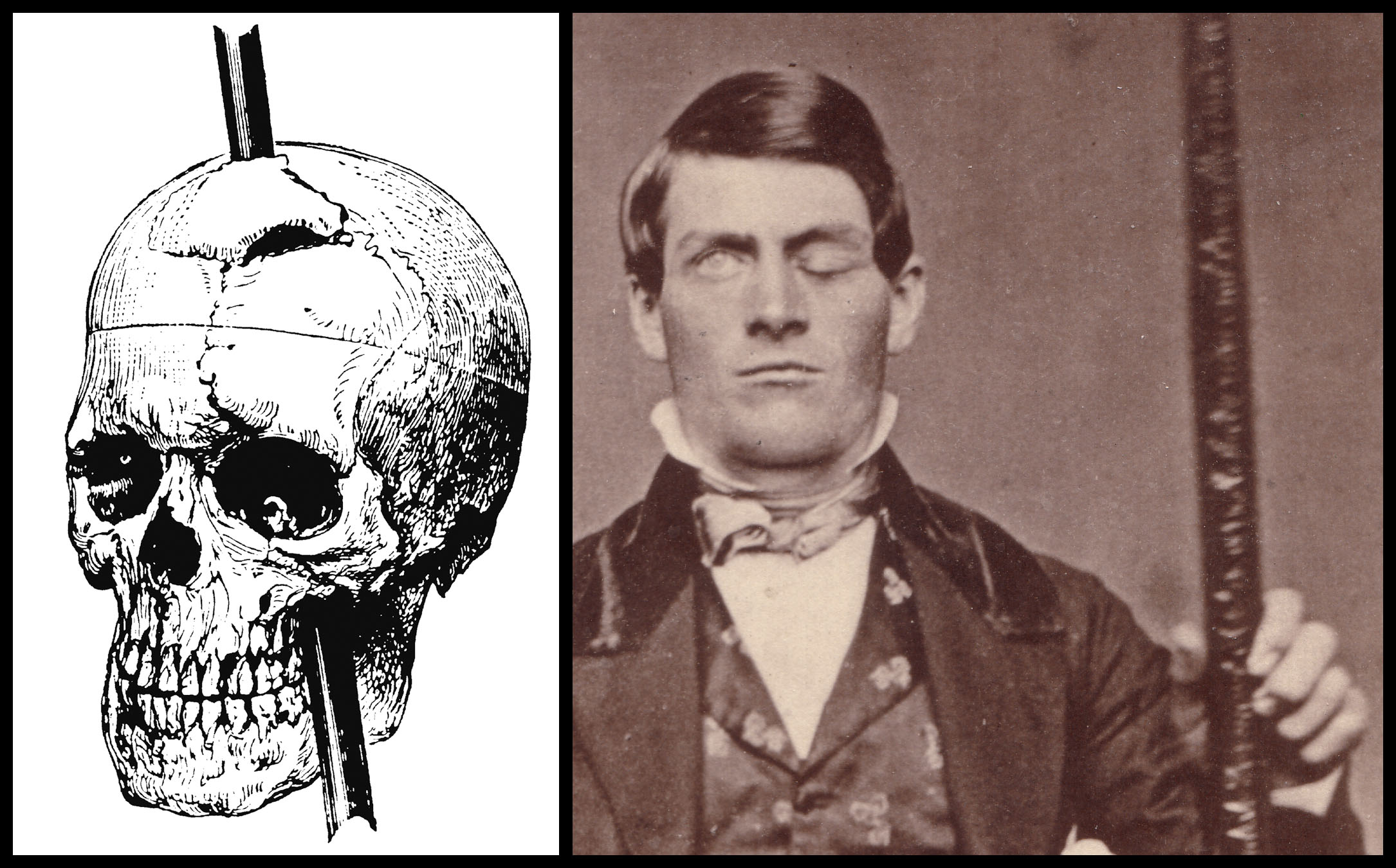 Image result for phineas gage xray