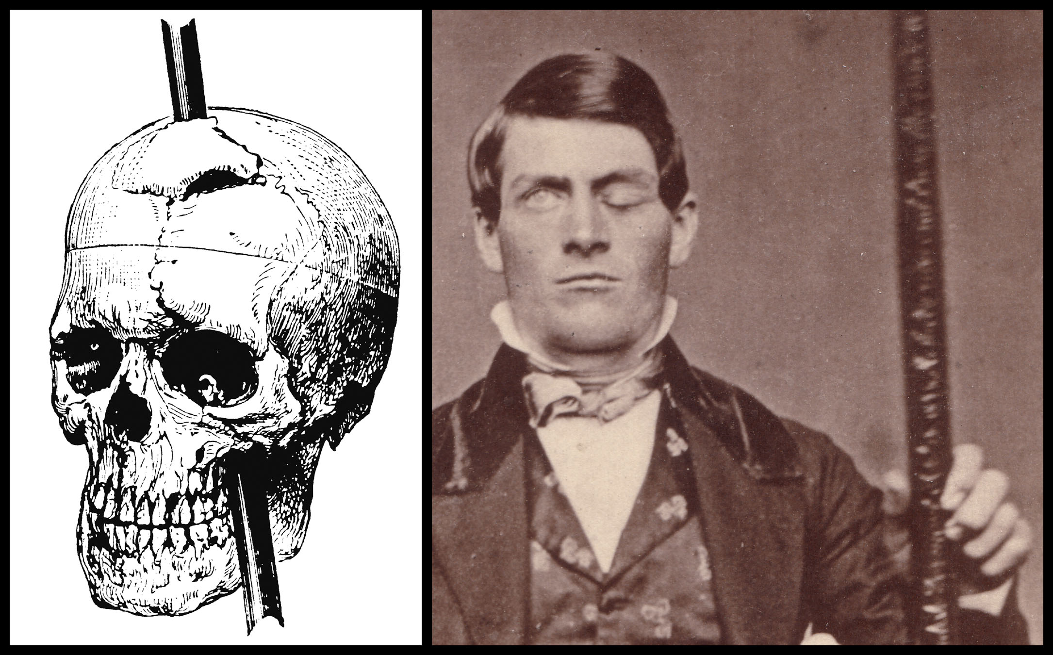 Phineas Gage Is A True Story Stranger Things Gave Us The Low Down